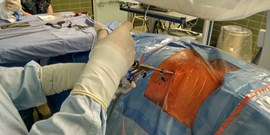 Endoskopická operace výhřezu meziobratlové ploténky. Jako první v&#160;ČR.