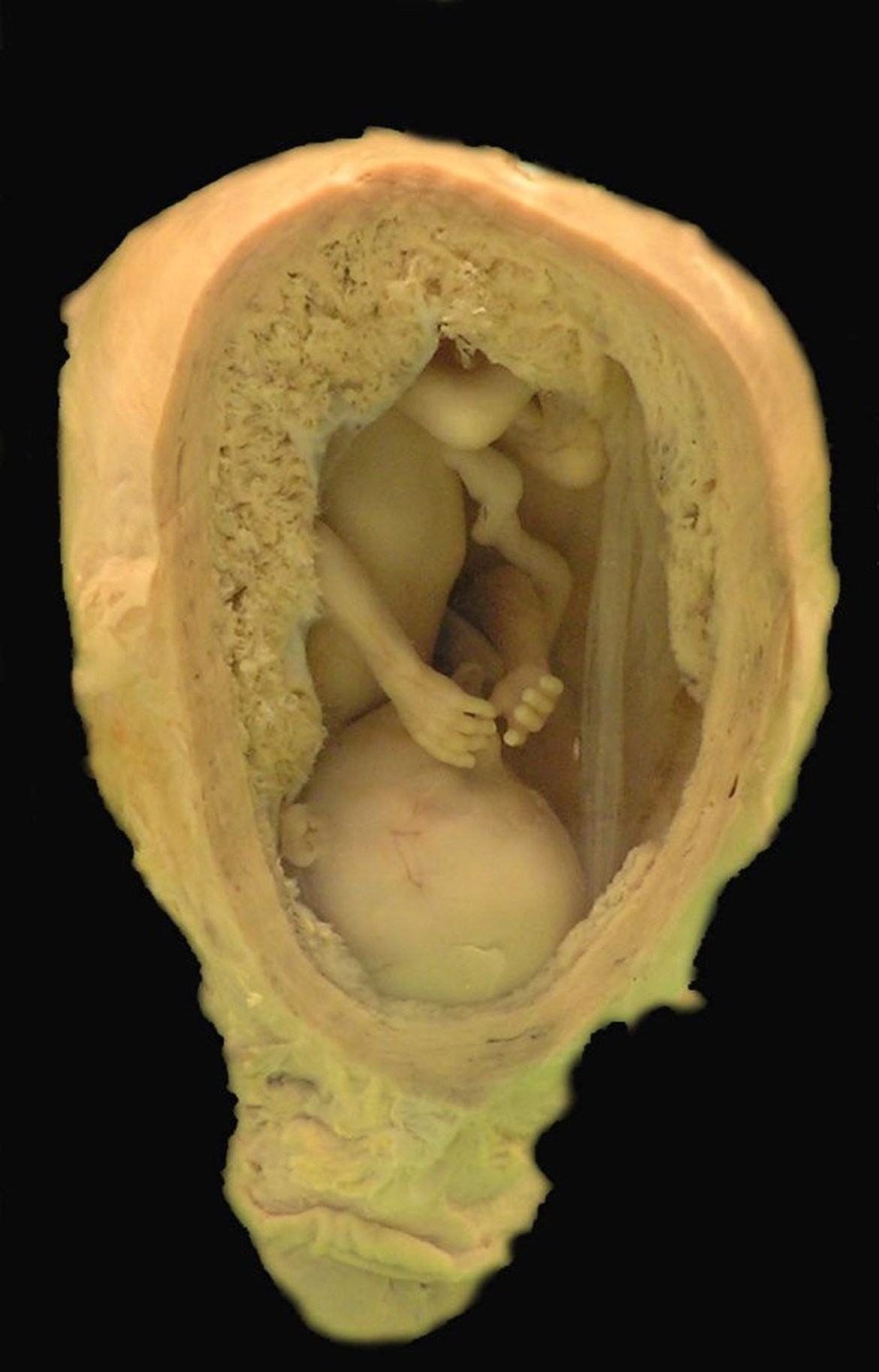 Čtyřměsíční plod v děloze