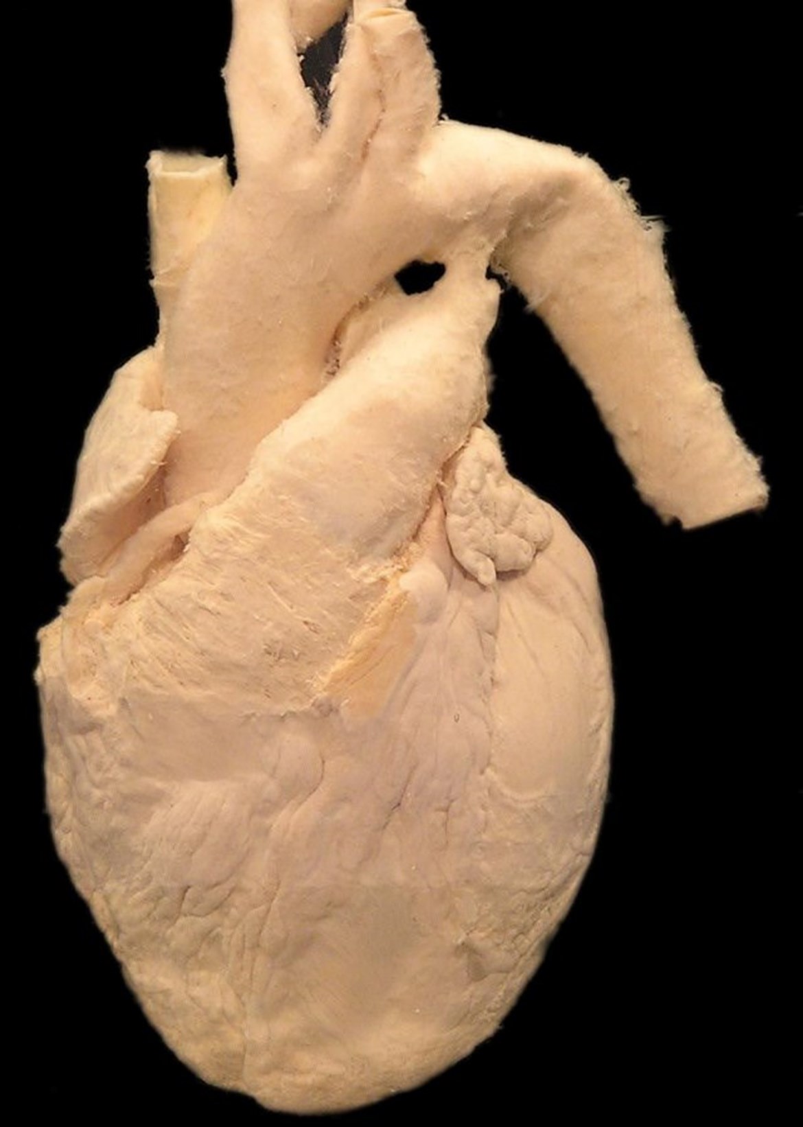 Lidské srdce s velkými cévami (aorta, truncus pulmonalis, horní dutá žíla)