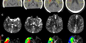 Detection of ischemic changes on baseline multimodal computed tomography: expert reading vs. Brainomix and RAPID software