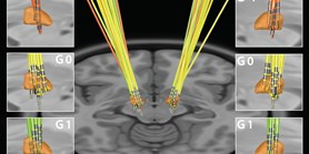 Suboptimal response to STN-DBS in Parkinson's&#160;disease can be identified via reaction times in a&#160;motor cognitive paradigm 