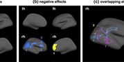 Temporally and sex-specific effects of maternal perinatal stress on offspring cortical gyrification and mood in young adulthood