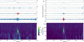 High frequency oscillations in epileptic and non-epileptic human hippocampus during a&#160;cognitive task