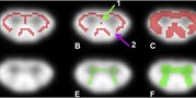 Voxelwise analysis of diffusion MRI of cervical spinal cord using tract-based spatial statistics