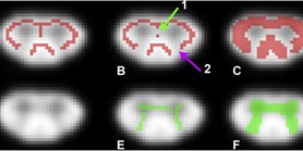 Voxelwise analysis of diffusion MRI of cervical spinal cord using tract-based spatial statistics