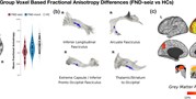 Individual differences in interoceptive accuracy and prediction error in motor functional neurological disorders: A&#160;DTI study