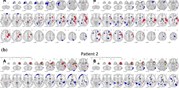 Arterial Spin Labeling is a&#160;Useful MRI Method for Presurgical Evaluation in MRI-Negative Focal Epilepsy 