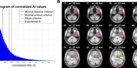 Epileptogenic zone detection in MRI negative epilepsy using adaptive thresholding of arterial spin labeling data 