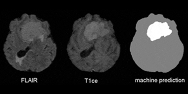 Brain tumor segmantation and classification