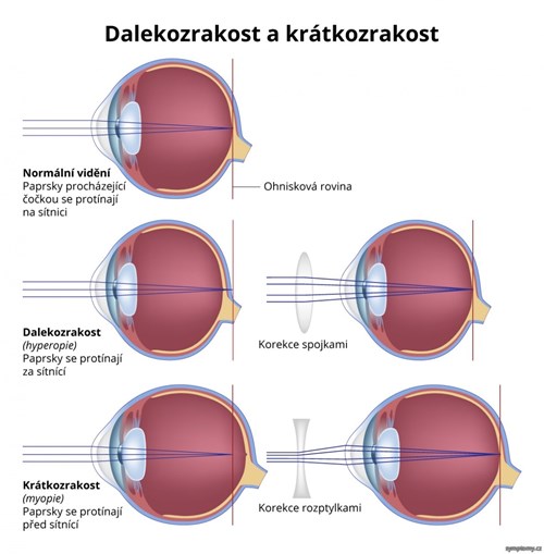 Krátkozrakost a dalekozrakost