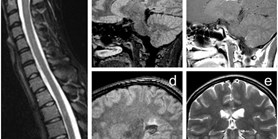 Progressive Tumefactive Demyelination as the Only Result of Extensive Diagnostic Work-Up: A&#160;Case Report 