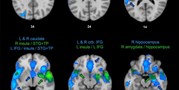 Cognitive impairment and depression: Meta-analysis of structural magnetic resonance imaging studies