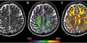 Alterations in Sensorimotor and Mesiotemporal Cortices and Diffuse White Matter Changes in Primary Progressive Multiple Sclerosis Detected by Adiabatic Relaxometry