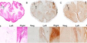 Transduction profiles in minipig following MRI guided delivery of AAV-5 into thalamic and Corona Radiata areas