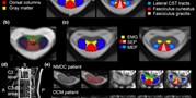 Diffusion magnetic resonance imaging reveals tract-specific microstructural correlates of electrophysiological impairments in non-myelopathic and myelopathic spinal cord compression