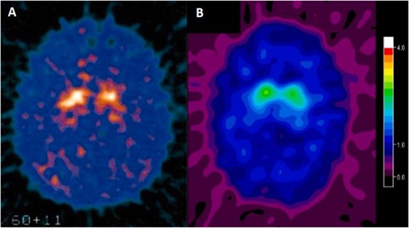 WARS2 mutations cause dopa-responsive early-onset parkinsonism and ...