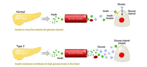 Schématické znázornění toho, jak se v organismu projevuje diabetes 2. typu.