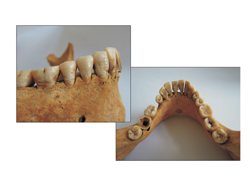 Enamel hypoplasia, tooth decay and tartar deposits in one of the individuals 