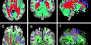 Evaluating Magnetic Resonance Diffusion Properties Together with Brain Volumetry May Predict Progression to Multiple Sclerosis