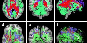 Evaluating Magnetic Resonance Diffusion Properties Together with Brain Volumetry May Predict Progression to Multiple Sclerosis