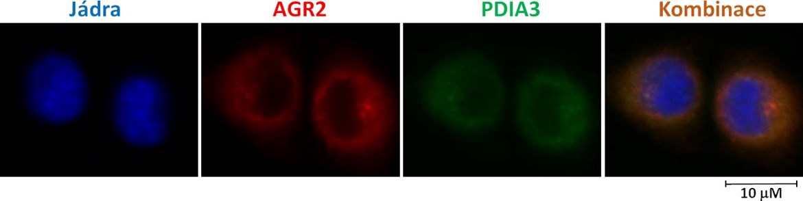Ukázka lokalizace proteinů AGR2 a PDIA3 v nádorových buňkách A549 získaných z karcinomu plic pořízená pomocí fluorescenčního mikroskopu. 