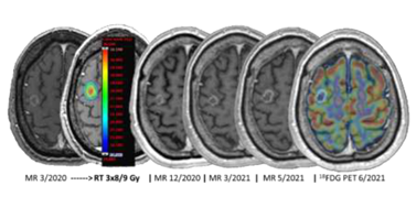 Radiomická analýza MRI v radioterapii mozkových metastáz