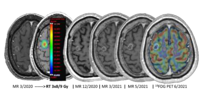 Mri Radiomic Analysis In Radiotherapy Of Brain Metastases Fi Centre