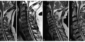 Degenerative Cervical Myelopathy: Development and Natural History [AO Spine RECODE-DCM Research Priority Number 2]