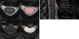 Semi-automated detection of cervical spinal cord compression with the Spinal Cord Toolbox