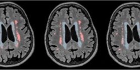 Differential spatial distribution of white matter lesions in Parkinson's&#160;and Alzheimer's&#160;diseases and cognitive sequelae