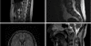 Relapsing MRI-negative myelitis associated with myelin-oligodendrocyte glycoprotein autoantibodies: a&#160;case report