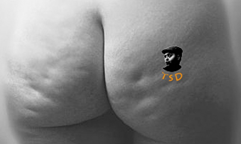 Celulitida na hýždích.