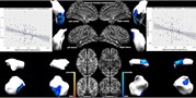 Perinatal maternal mental health and amygdala morphology in young adulthood