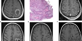 Prolonged survival in patients with local chronic infection after high-grade glioma treatment: Two case reports