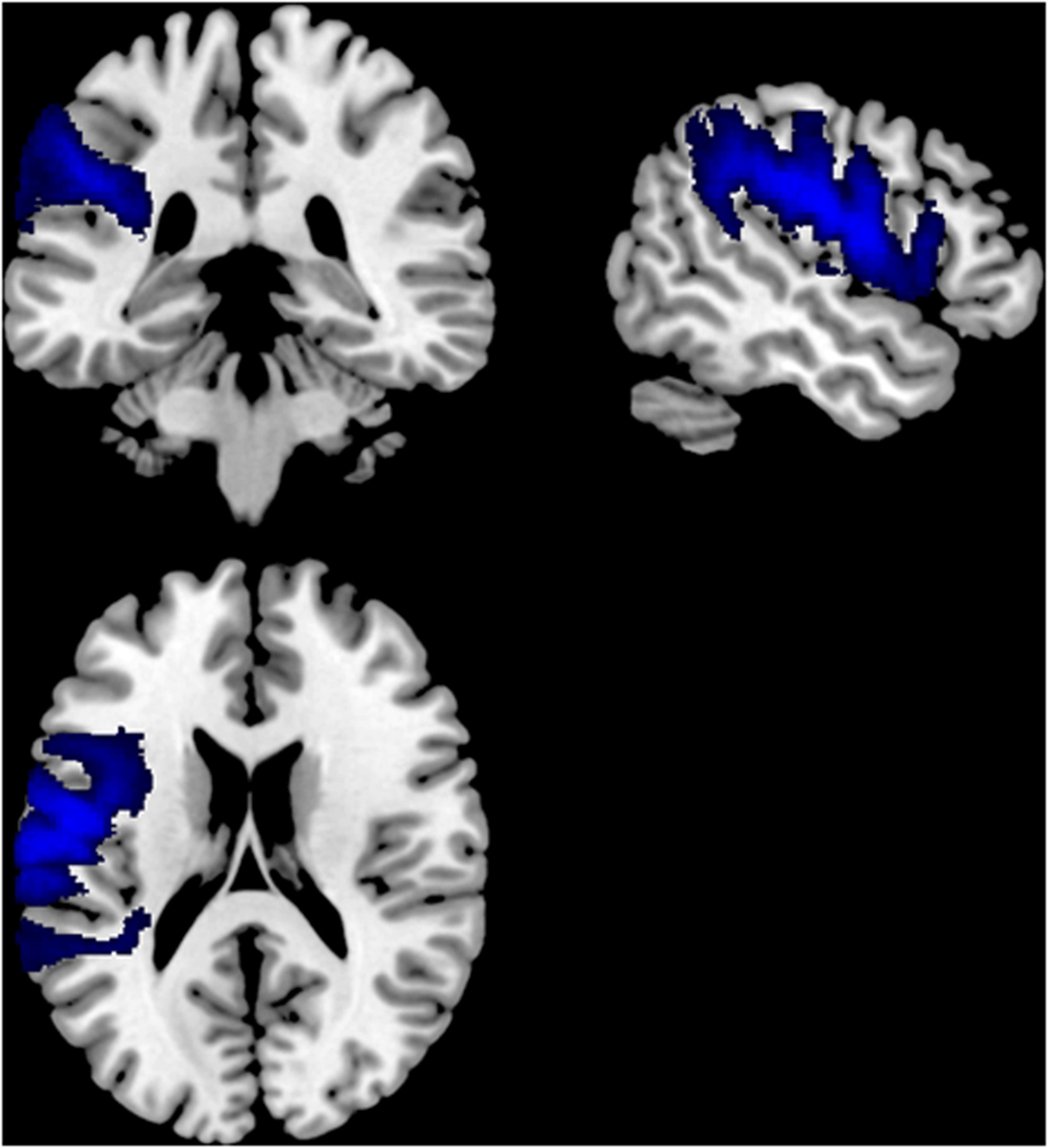 Repetitive Transcranial Magnetic Stimulation For Hypokinetic Dysarthria ...