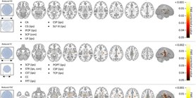 White matter alterations in MR-negative temporal and frontal lobe epilepsy using fixel-based analysis