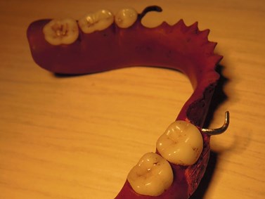 Zubní náhrada