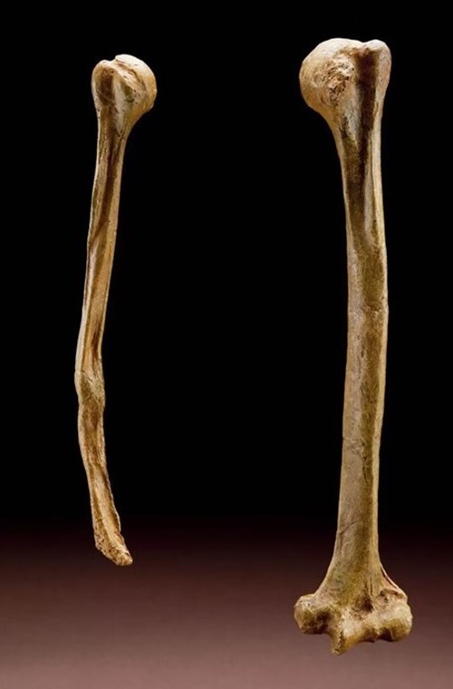Pažní kosti (humerus) muže Shanidar 1 (Nandy). Jak je na obrázku patrné, tak pravá pažní kost je menší a chybí distální část kosti, která byla amputována.