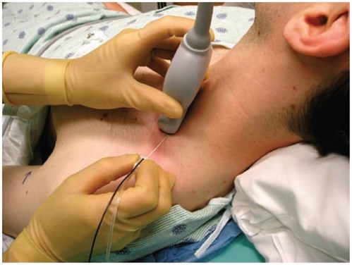 Ultrazvukem naváděná blokáda nervů horní končetiny.