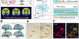 Molecular Biomarkers of Neuronal Injury in Epilepsy Shared with Neurodegenerative Diseases