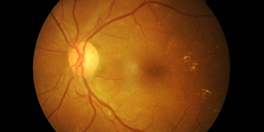 Retinal organoids as a tool for the study of embryonic diabetic retinopathy