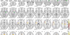 Lifelong effects of prenatal and early postnatal stress on the hippocampus, amygdala, and psychological states of Holocaust survivors