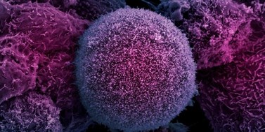 Prognostický význam nových biomarkerů identifikovaných na základě analýzy extracelulárních vesikulů izolovaných z ascitu u pacientek s ovariálním karcinomem