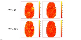 Water removal in MR spectroscopic imaging with Casorati singular value decomposition