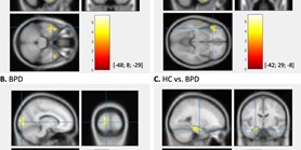 Neural correlates of social exclusion and overinclusion in patients with borderline personality disorder: an fMRI study