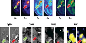 Imaging Biomarkers in Prodromal and Earliest Phases of Parkinson's&#160;Disease