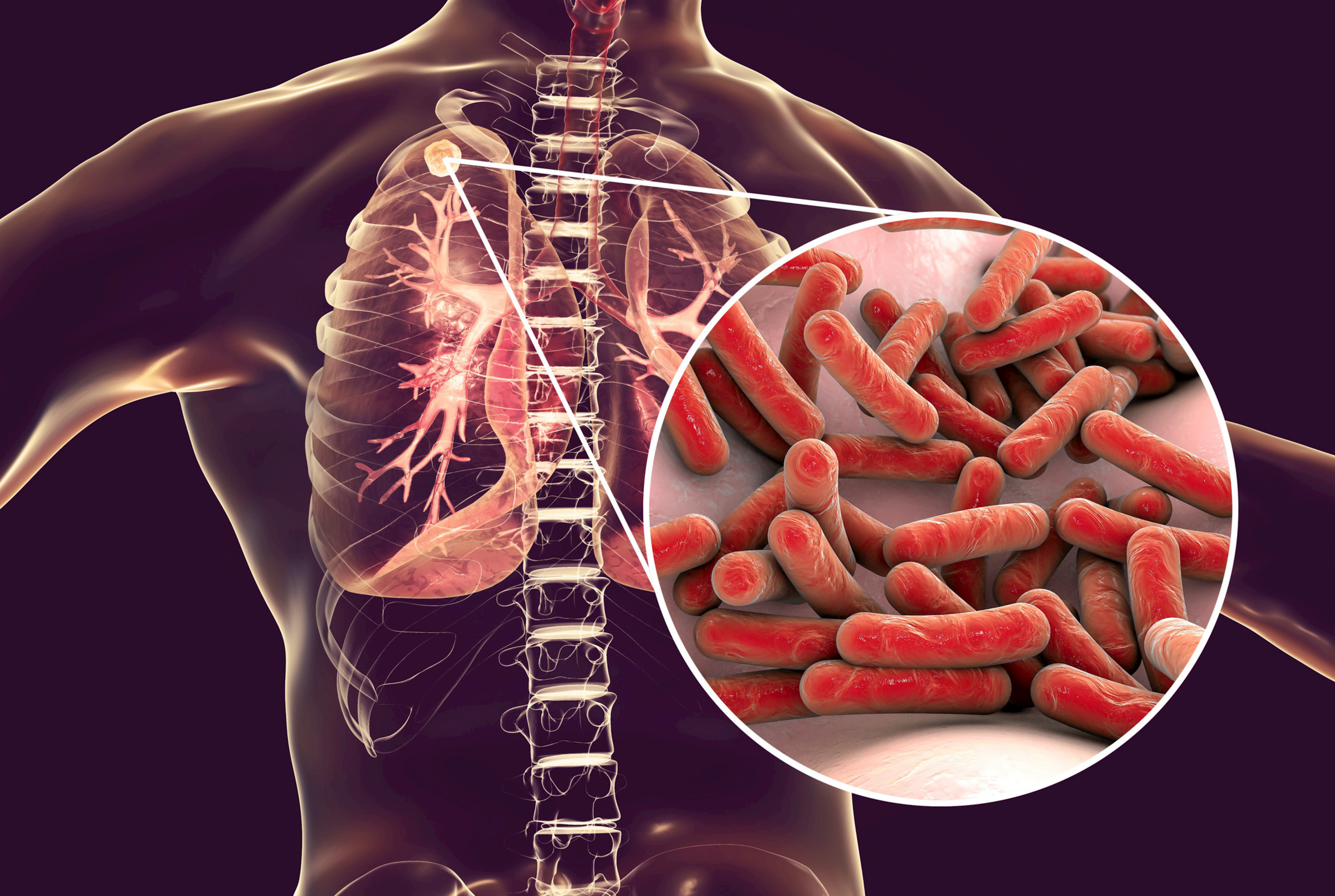 INHALE: Novel Inhaled Antibacterial Remedies for Multidrug-Resistant Pulmonary Diseases